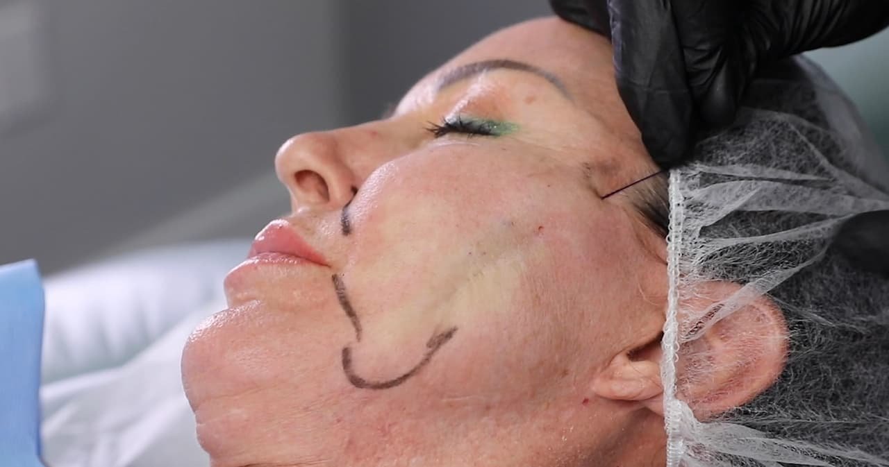 pdo thread treatment process, pdo