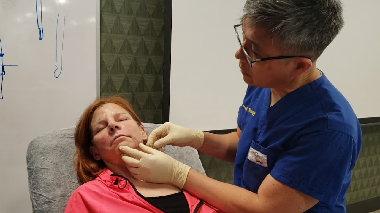 Medical professional performing PDO thread lift treatment on patient, highlighting non-invasive aesthetic procedure in clinical setting.