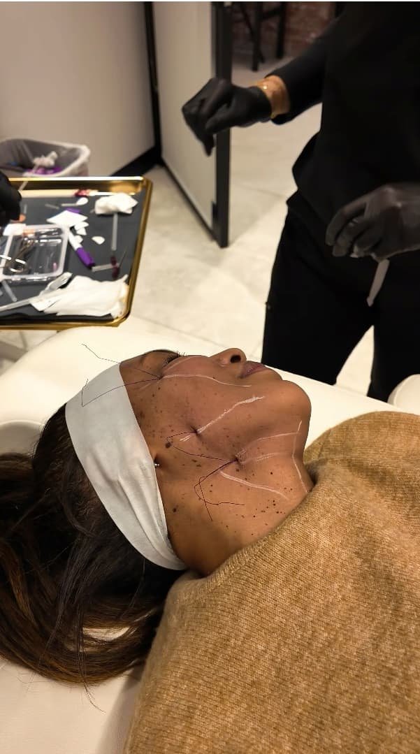 Patient receiving PDO thread lift treatment, with visible threads on the face, in a clinical setting, highlighting aesthetic enhancements and skin tightening.
