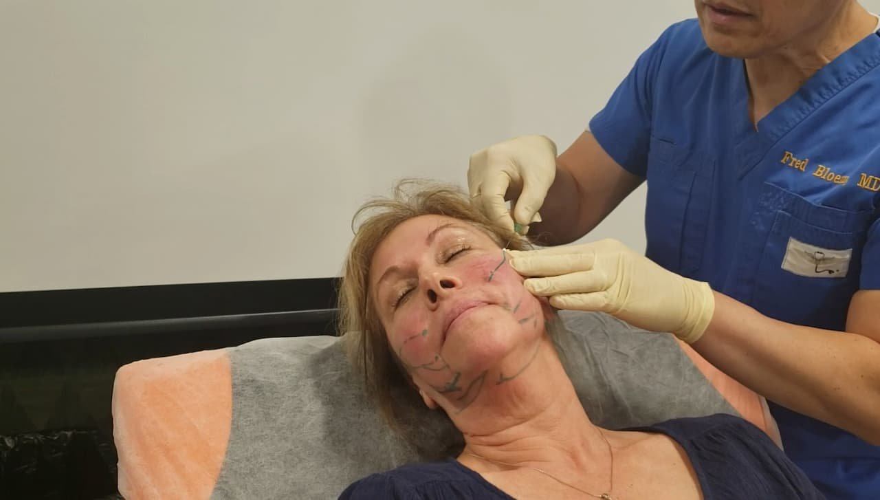 Patient receiving PDO thread lift treatment from Dr. Fred Bloem, showcasing facial markings for lifting and tightening skin.