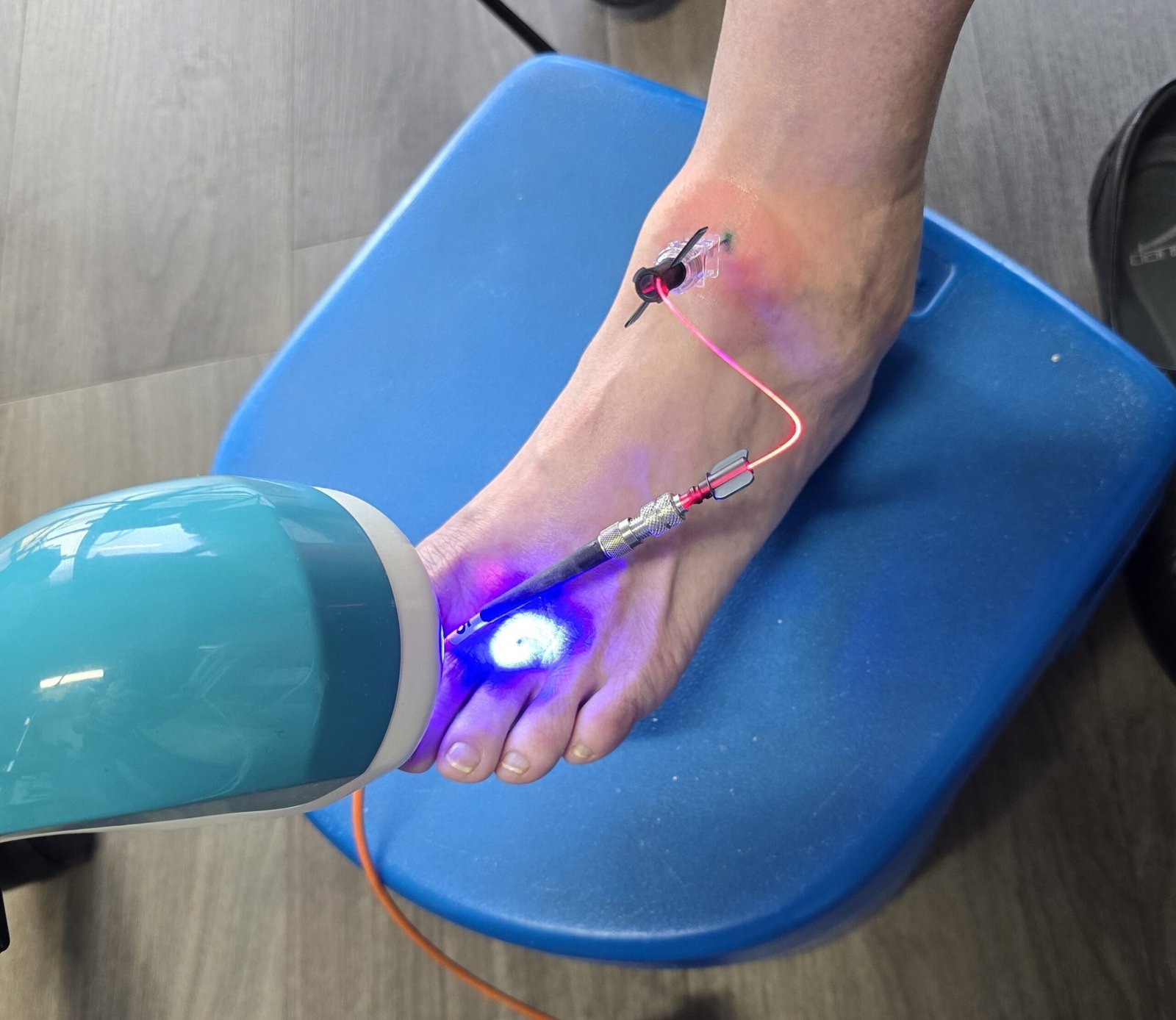 Intra-articular laser therapy treatment on foot, showcasing laser application with Weberneedle Endolaser for joint regeneration and pain relief.