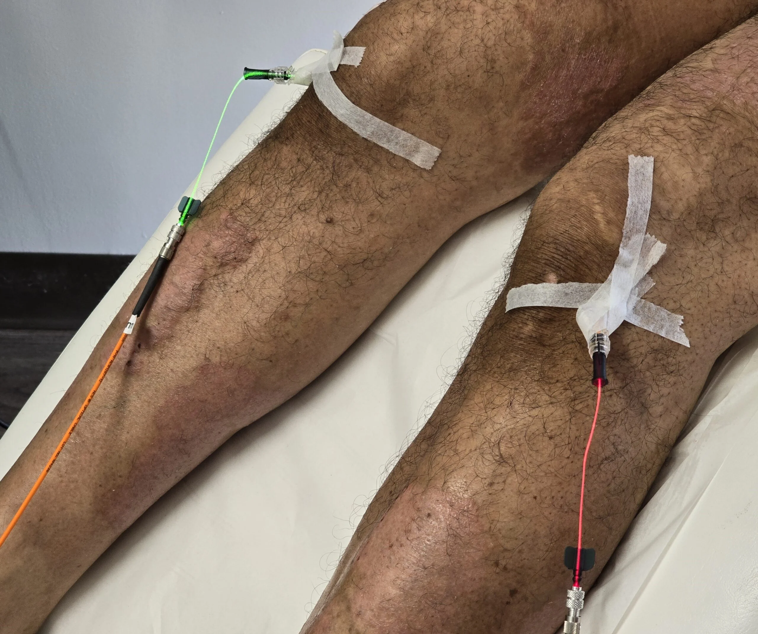 Intra-articular Laser Therapy &ndash; Fred Bloem MD Kensington
