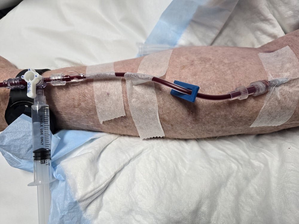 Patient's arm with IV setup for Extracorporeal Blood Oxygenation and Ozonation (EBOO) therapy, showcasing syringe and blood circulation equipment, emphasizing holistic medical treatment.
