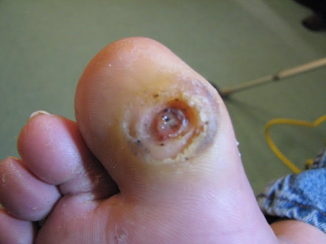 Maggot Debridement Therapy session by Dr. Fred Bloem, MD, showcasing biotherapy for effective wound care.